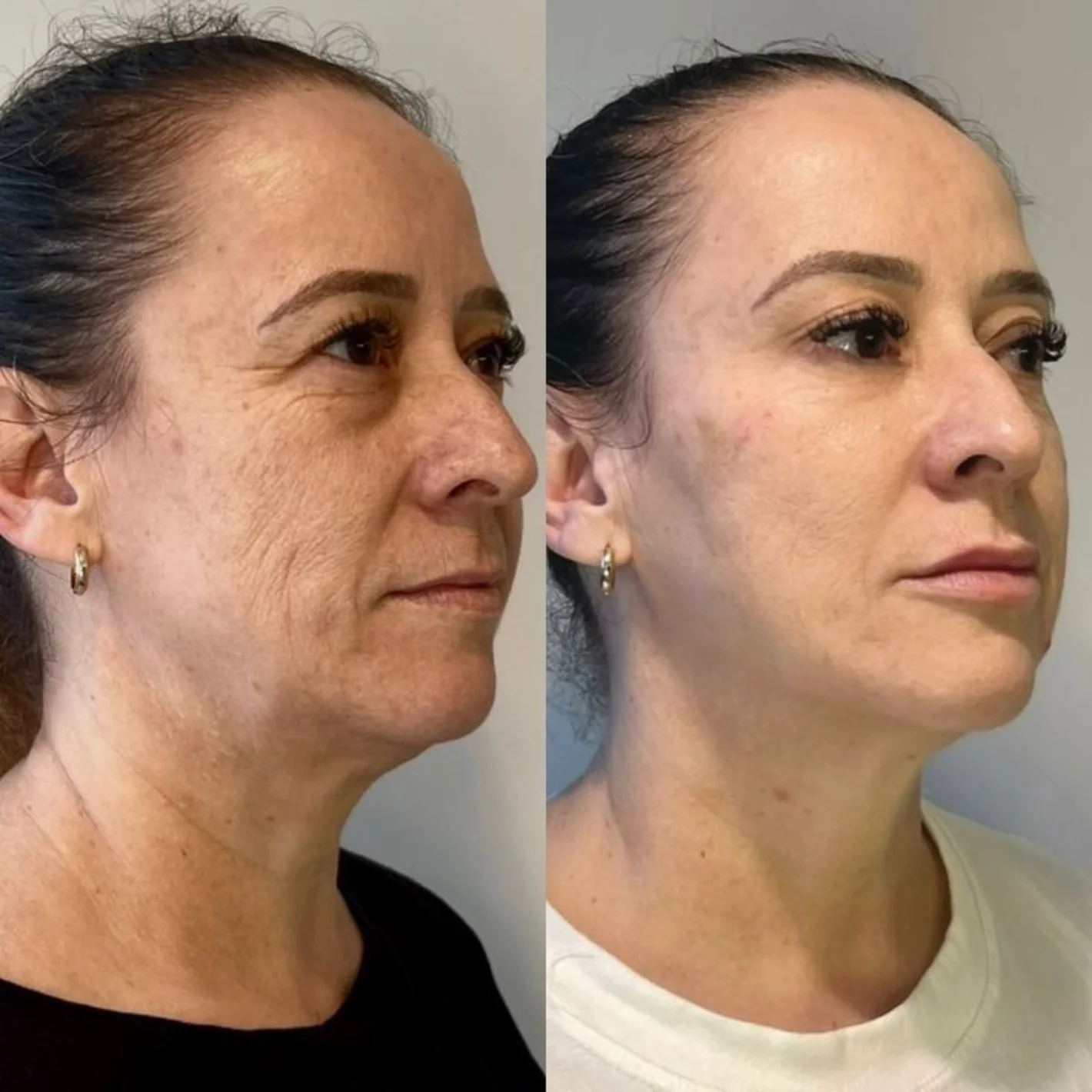 Masajeador Facial Reafirmante PRO